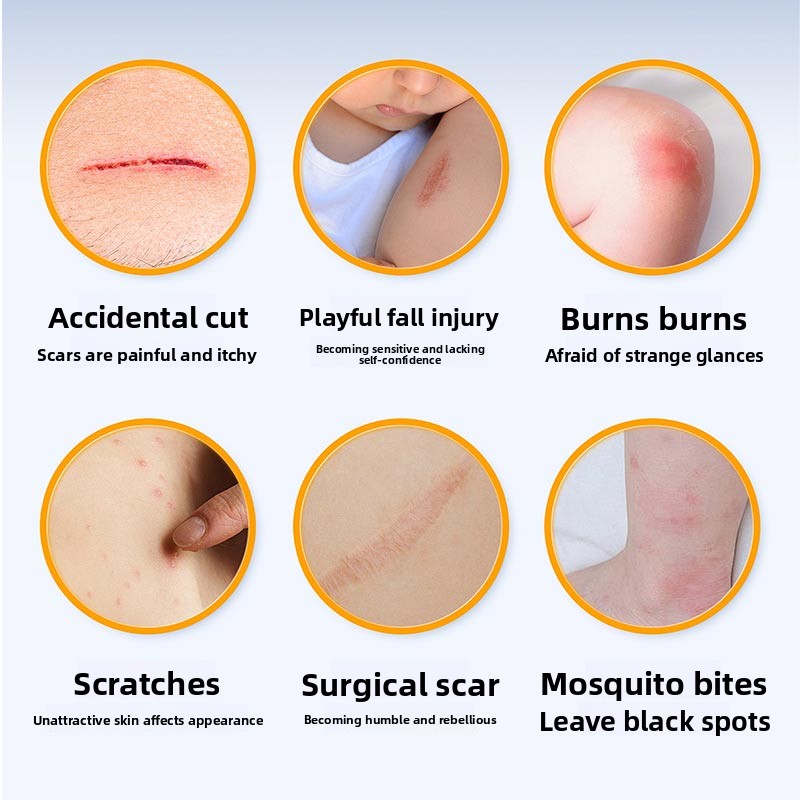 Medical scar repair cream, can repair acne marks/depressed scars/stretch marks/pigmentation scars/surgical scars/burn scars, etc. Hypoallergenic and moisturizing repair!