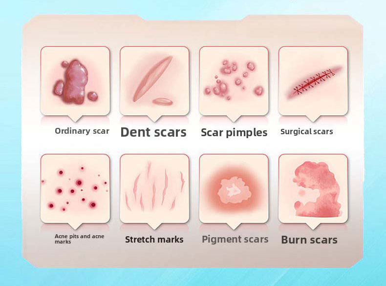 Medical scar repair cream, can repair acne marks/depressed scars/stretch marks/pigmentation scars/surgical scars/burn scars, etc. Hypoallergenic and moisturizing repair!