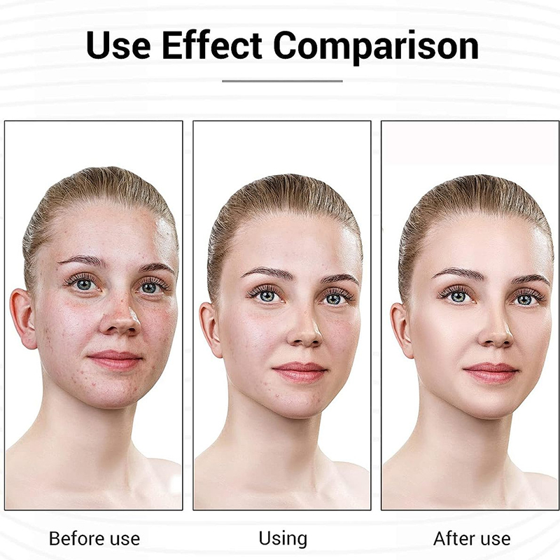 Facial chitosan wound dressing. Hydrating and moisturizing mask to prevent skin aging