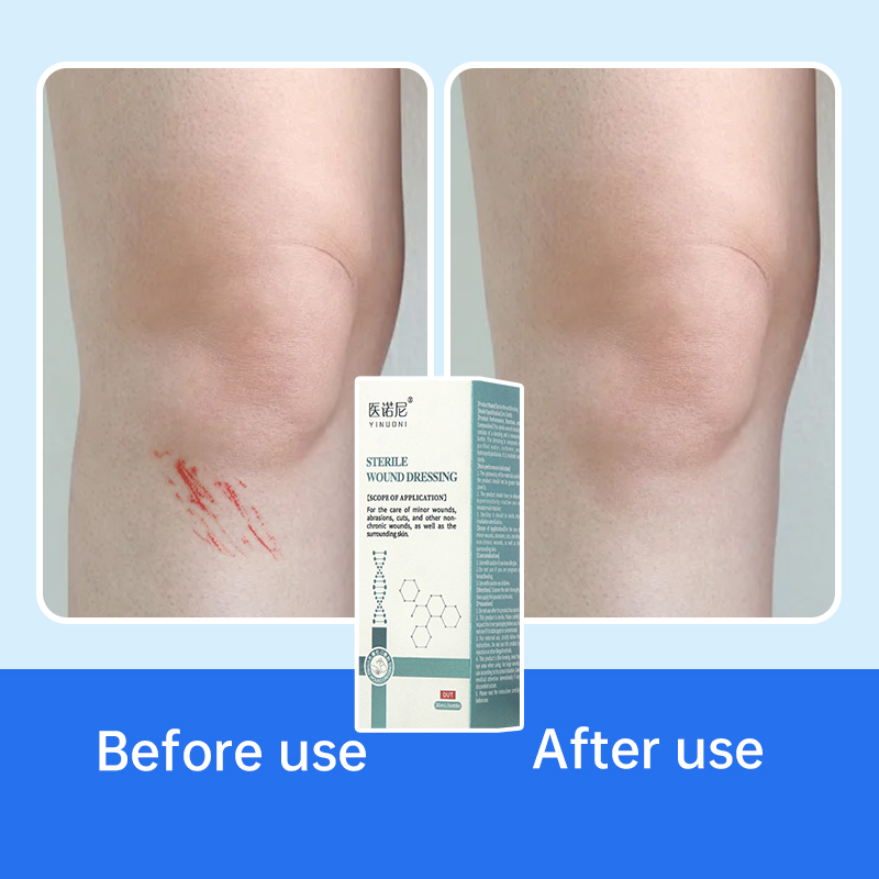 Skin-friendly sterile spray wound dressing for cuts, scrapes, lacerations, and burns. 30-second curing film, waterproof and quick-drying, for medical wound dressings for home use.