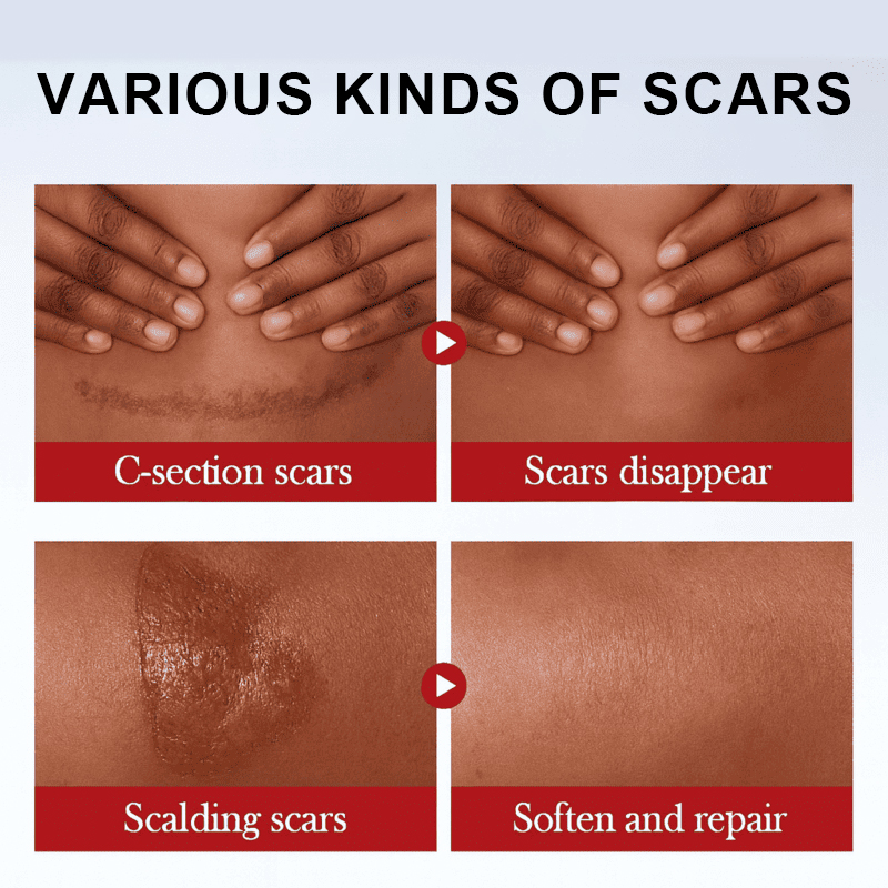 This medical-grade scar repair cream can repair acne scars, atrophic scars, stretch marks, pigmentation scars, surgical scars, burn scars, and more. Suitable for all skin types!
