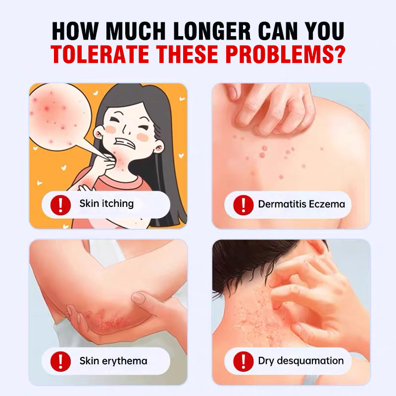 Renhe Medical Eczema Spray. Treats dermatitis, skin erythema, itching, peeling, and acne.