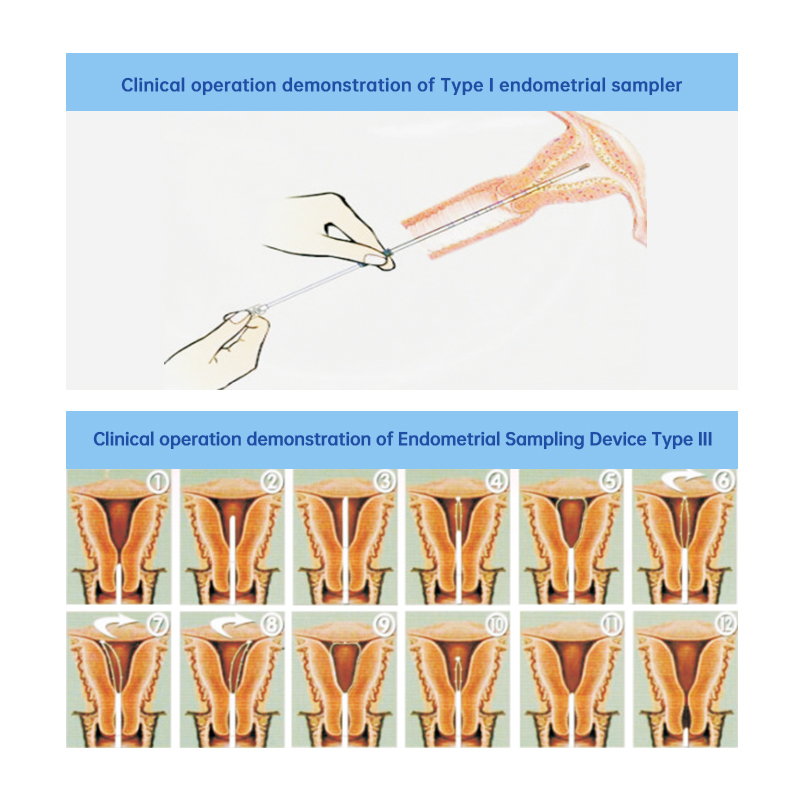 Disposable Endometrial Sampler